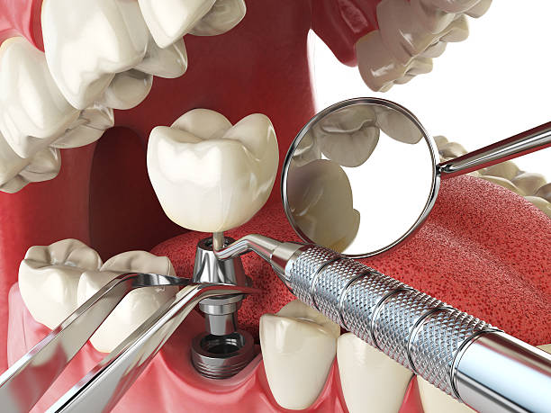 Best Emergency Tooth Extraction in Mount Vernon, VA